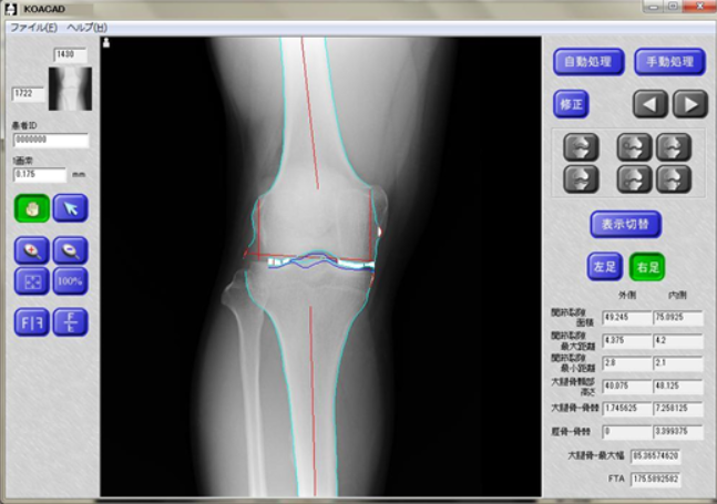 膝関節診断支援システム『KOACAD』 